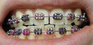 Custom Braces Colors