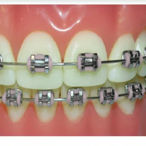Custom Braces Colors